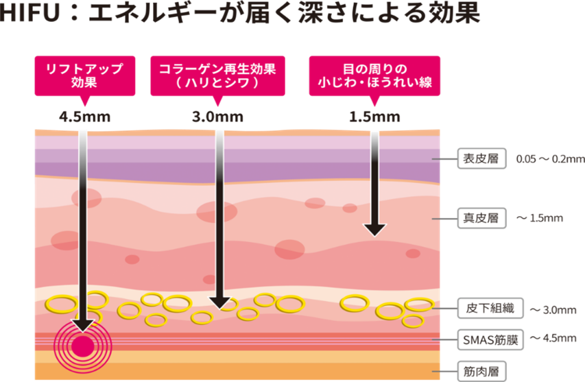 顔HIFU